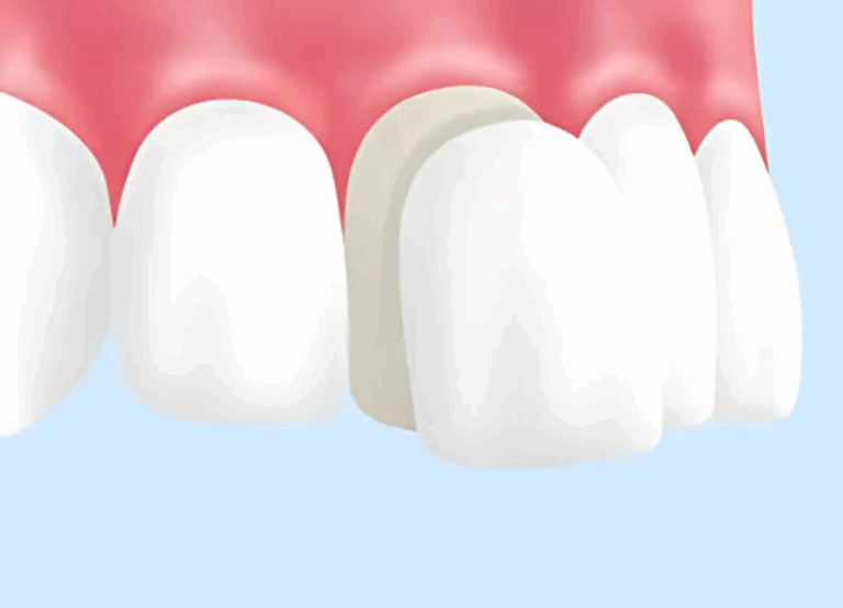 ラミネートベニア|ワンズ歯科