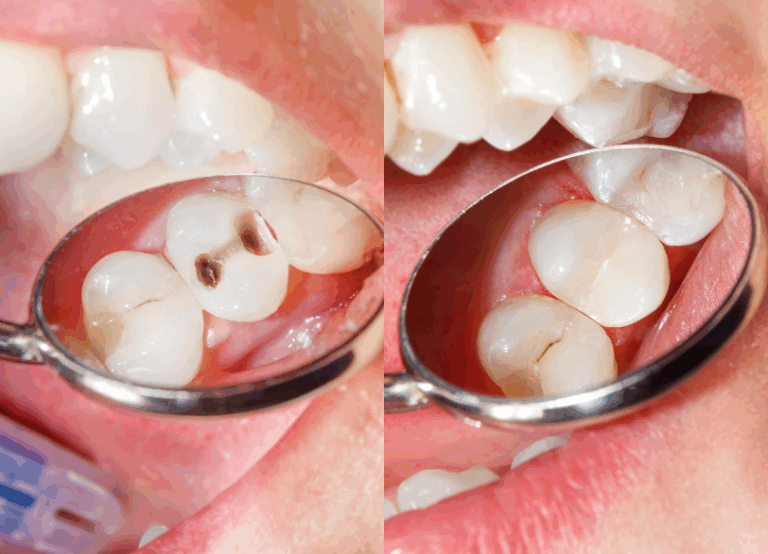 ダイレクトボンディング|ワンズ歯科