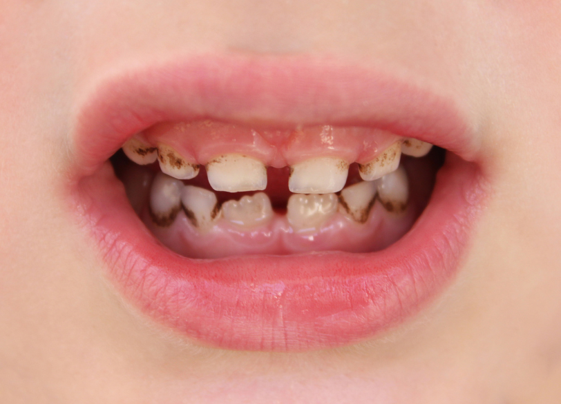 虫歯はうつる病気|ワンズ歯科