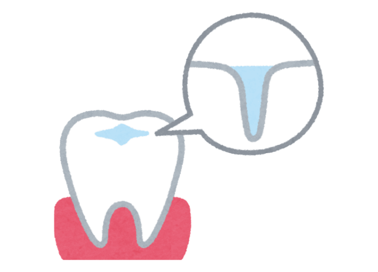 シーラント|ワンズ歯科