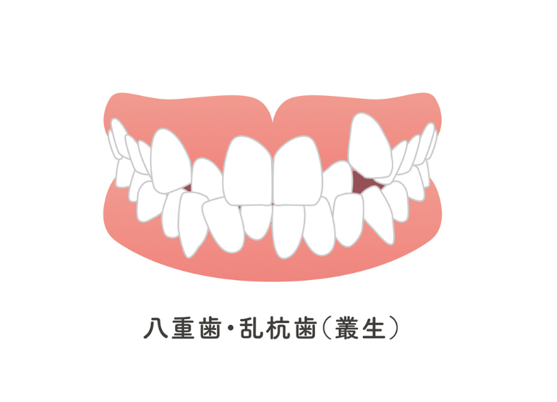 叢生|ワンズ歯科
