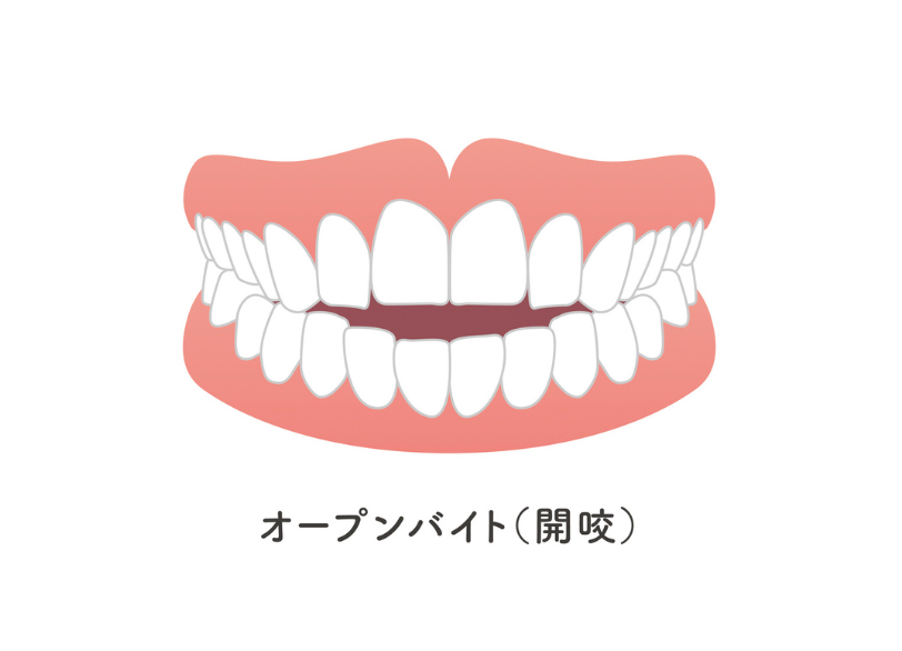 オープンバイト|ワンズ歯科