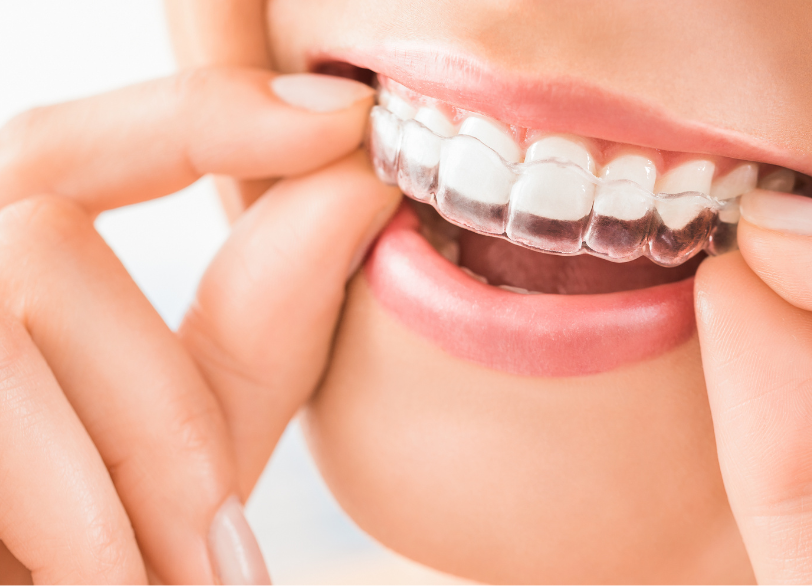 なぜ今大人の矯正治療なのか|ワンズ歯科