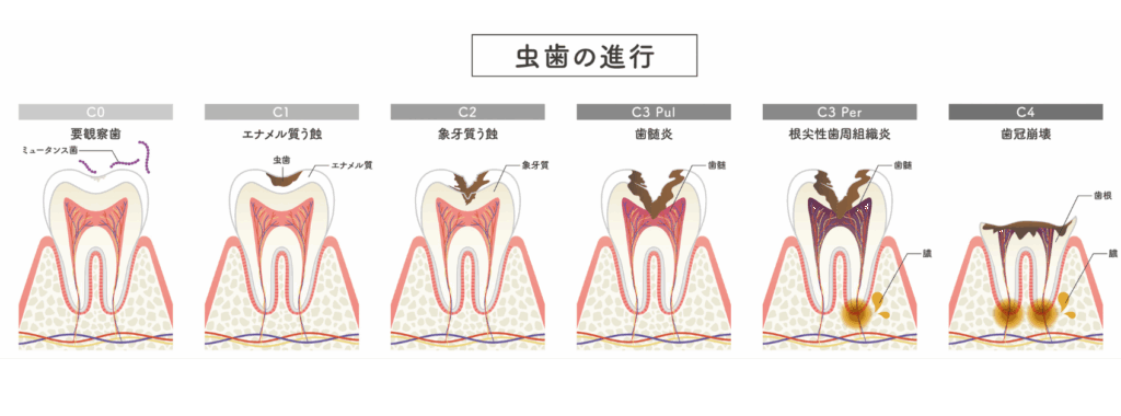 虫歯の進行|ワンズ歯科
