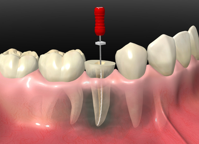 根管治療|ワンズ歯科