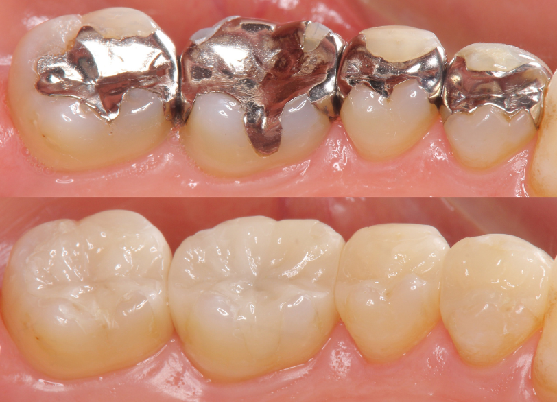 詰め物・被せ物へのこだわり|ワンズ歯科
