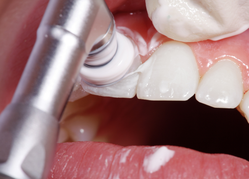 PMTC|ワンズ歯科