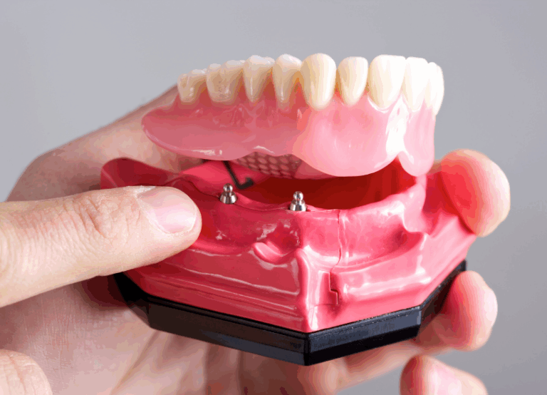 インプラントデンチャー|ワンズ歯科