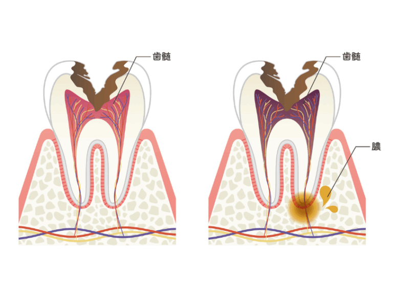 進行した虫歯|ワンズ歯科