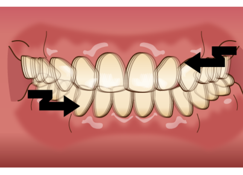 歯ぎしり|ワンズ歯科