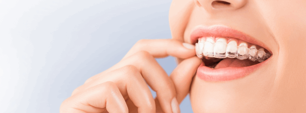 マウスピース矯正のメリット|ワンズ歯科