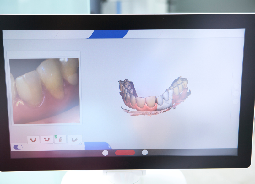 iTero|ワンズ歯科