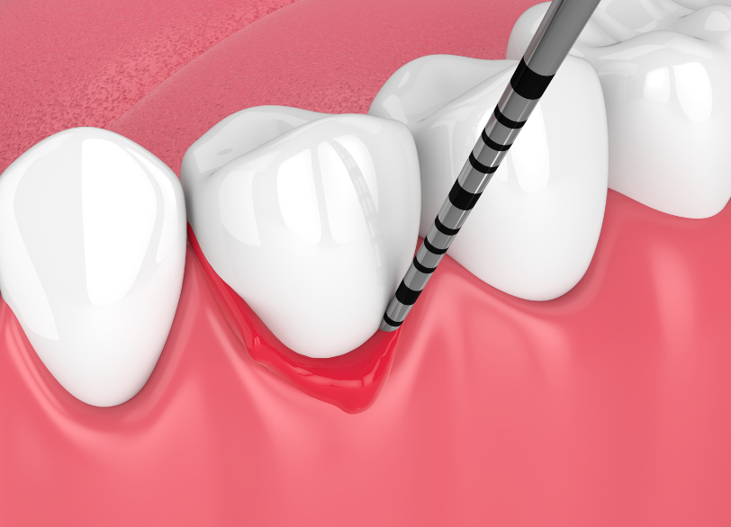 歯周病|ワンズ歯科