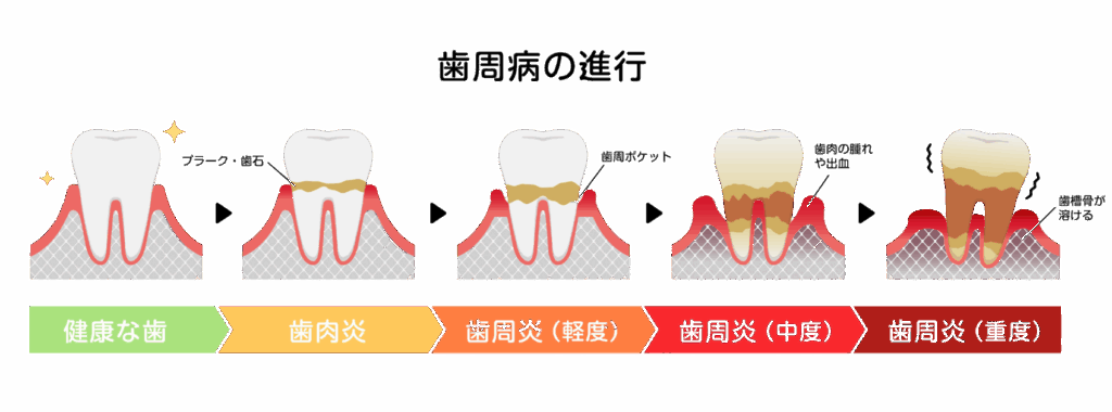 歯周病の進行過程|ワンズ歯科
