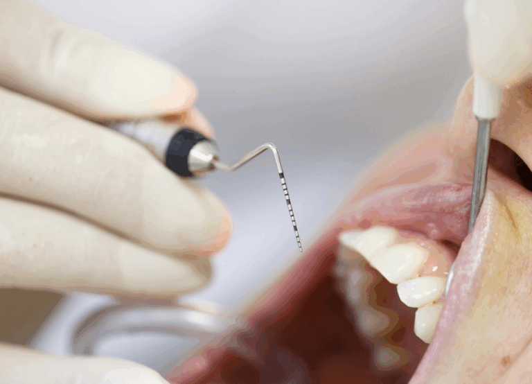 歯周ポケット検査|ワンズ歯科