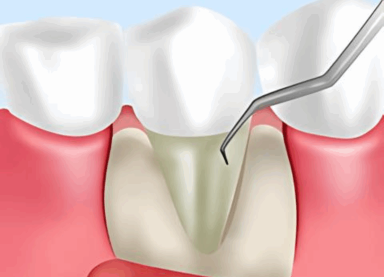フラップ手術|ワンズ歯科