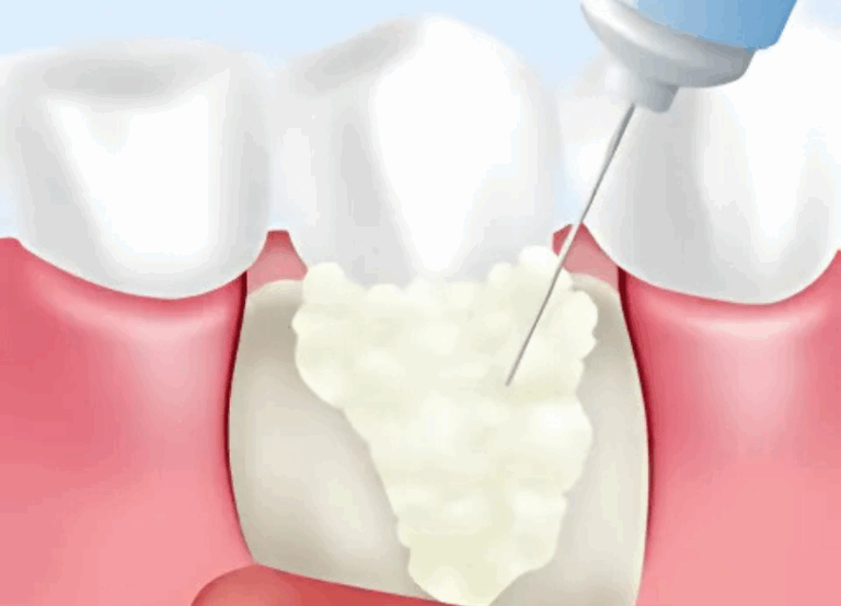 エムドゲイン法|ワンズ歯科