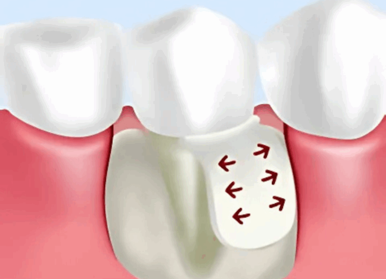 GTR法|ワンズ歯科