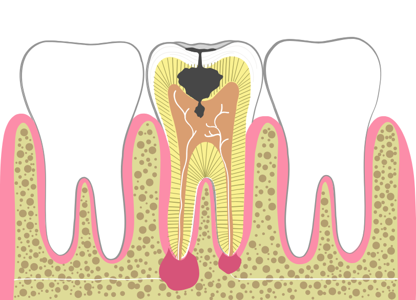 根管治療が必要な理由|ワンズ歯科