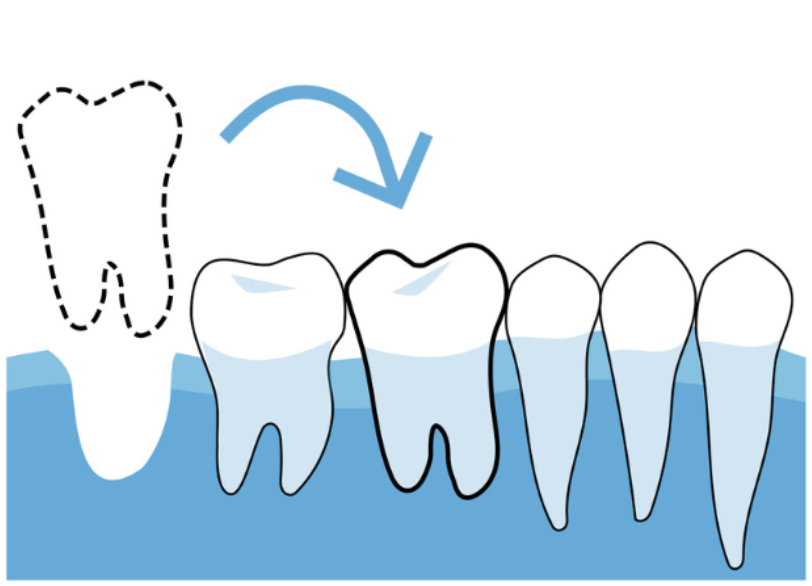 歯牙移植の基本原理|ワンズ歯科
