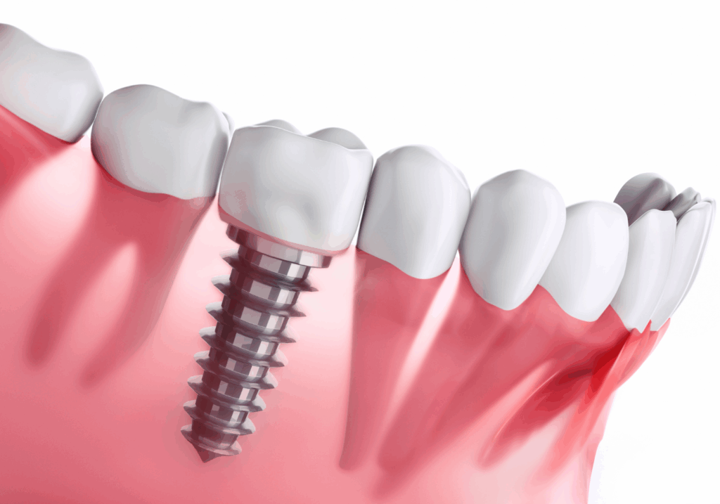 なぜインプラントが選ばれるのか|ワンズ歯科