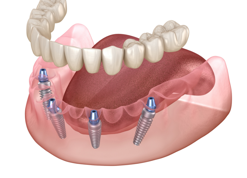 allon4|ワンズ歯科
