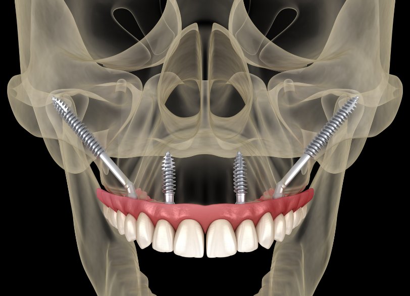 ザイゴマ|ワンズ歯科