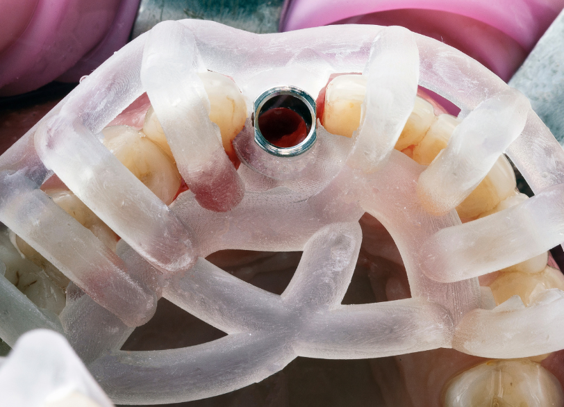 サージカルガイド|ワンズ歯科