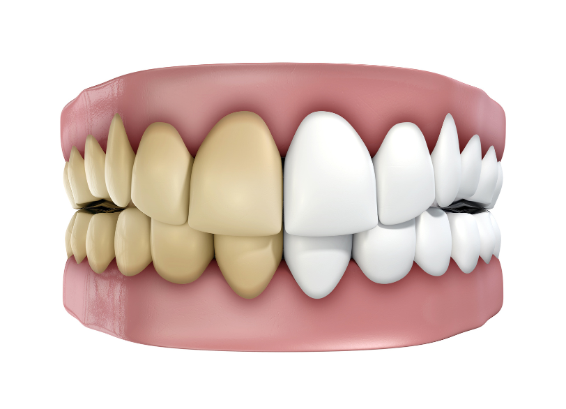 歯はなぜ色を変えるのか|ワンズ歯科