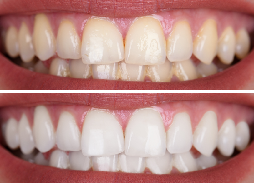 ホワイトニングとは|ワンズ歯科