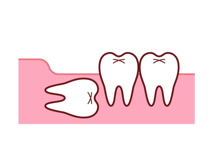 埋伏歯|ワンズ歯科