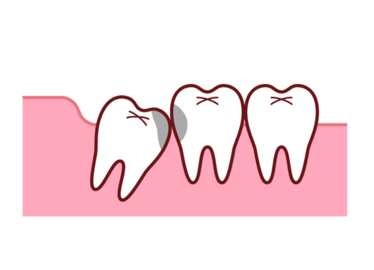 一番奥で磨きにくい|ワンズ歯科