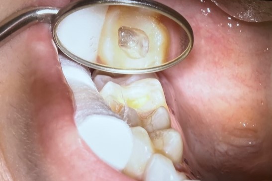 根管治療でネクストビジョンを使った治療のお写真になります。