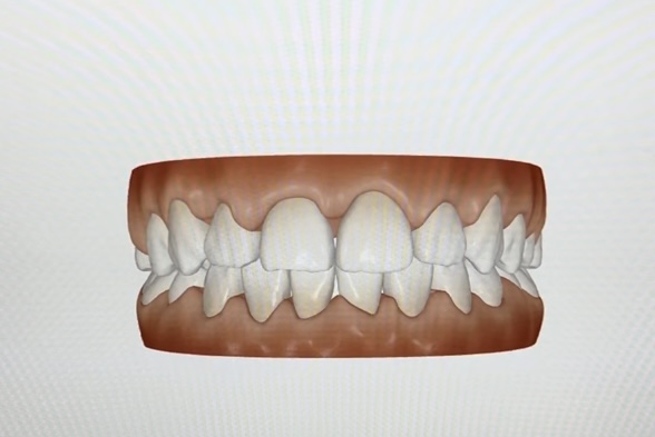 矯正したいが何から始めたらいいか、少し矯正に興味あるという方の為に当医院では【矯