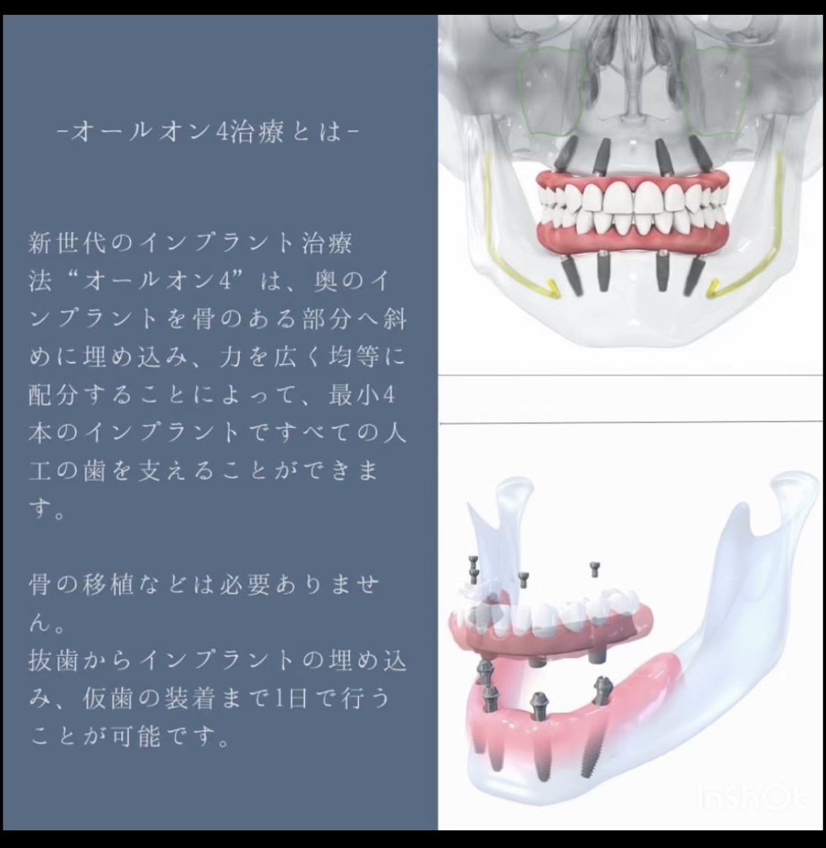 インプラント治療で健康と快適な食生活を